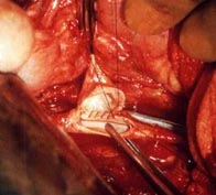Операции на артериях ног