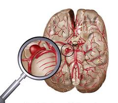 аневризма артерии мозга