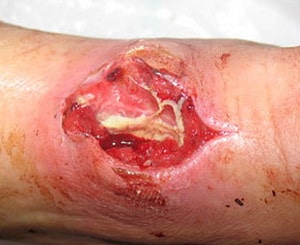 Некроз кожи после внутривенного катетера