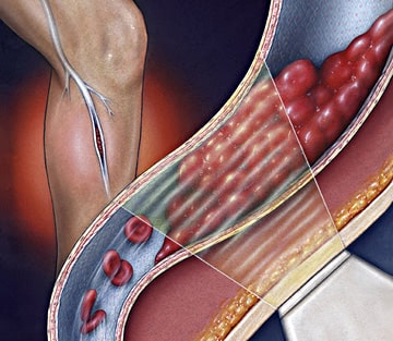 Удаление тромбов из артерии