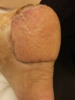Вид раны после пересадки свободного лоскута на ножке