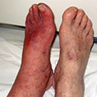 При критической ишемии пациент сидит с опущенной ногой, вследствие чего, стопа отекает и становиться багровой.