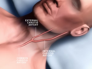 Стентирование сонных артерий