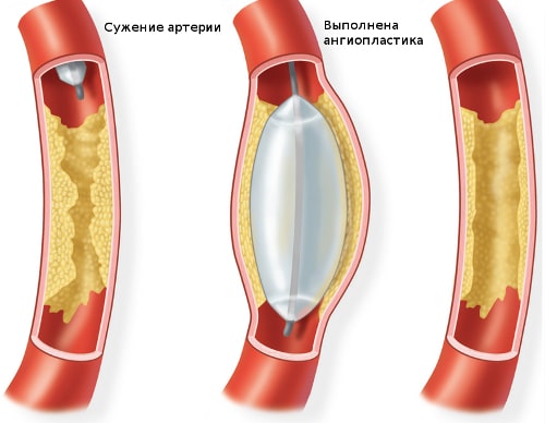 Баллонная ангиопластика артерий конечностей