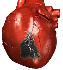 Атеросклероз - причина инфаркта